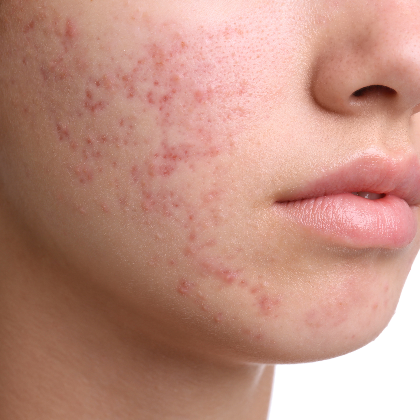 Prescriptive Acne Treatment
